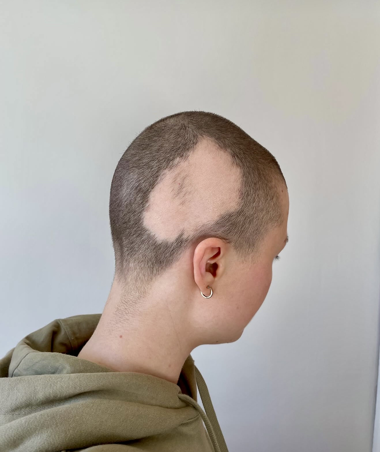 Client before her HEADS wig, close-shaved hair