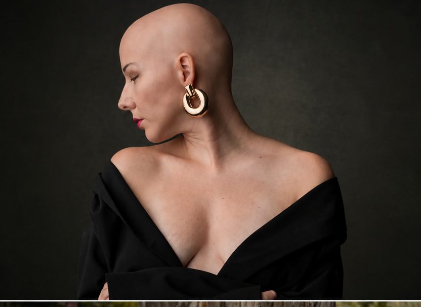 Portrait of a woman with alopecia, elegant and confident without a wig